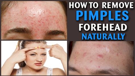 Get Rid Of Bumps On Forehead Overnight - get rid of bumps