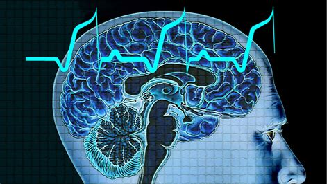 Management of Idiopathic Generalized Epilepsies - UW Medicine Provider ...