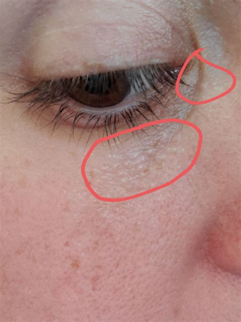 Under Eye Bumps, NOT milia | Undereye skin, Dry skin under eyes, Bumps under eyes
