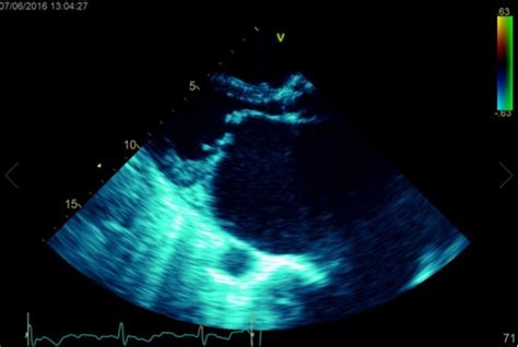 Massive Left Atrium from Severe Mitral Stenosis due to Rheumatic Heart Disease: Clinical Images ...