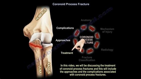 Coronoid Process Fracture Treatment ,approaches Everything You Need To Know - Dr. Nabil Ebraheim ...