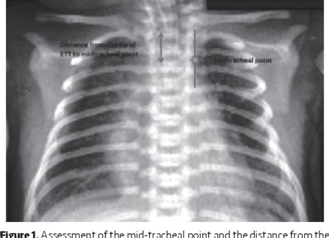 Endotracheal Tube Placement X Ray