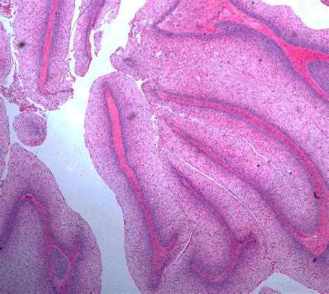 Pathology Outlines - Benign, borderline and malignant Brenner tumors