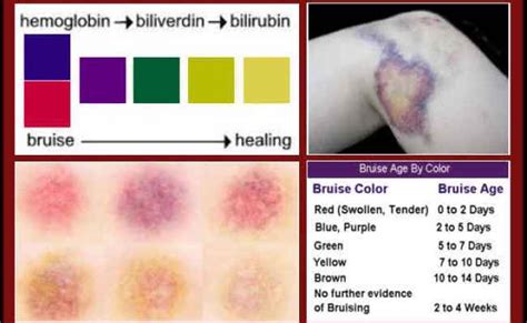 Stages Of Bruising Colors Pictures Chart And Different Bruise Healing ...