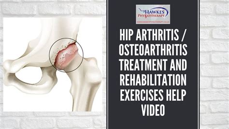 Hip arthritis / osteoarthritis treatment and rehabilitation exercises help video - YouTube