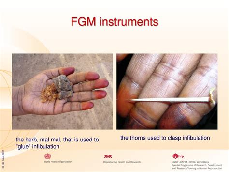 PPT - Female Genital Mutilation and Obstetric Outcome: How to take the results to doctors and ...