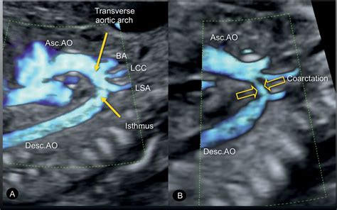 Coarctation of the Aorta and Interrupted Aortic Arch | Obgyn Key