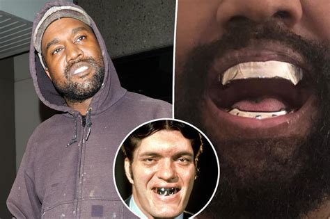 Kanye West has teeth removed and replaced with $850K titanium...