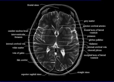 Cross sectional imaging anatomy thorax - youtube, This video deals with the anatomy of the ...