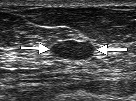 Breast Ultrasound Benign Mass - radRounds Radiology Network