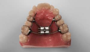 Hyrax - Johns Dental Lab