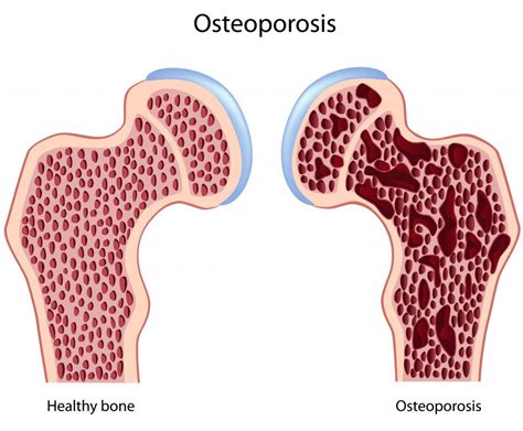 What Is Senile Osteoporosis? (with pictures)