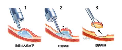 腸鏡檢查 | 悉尼大腸外科醫生