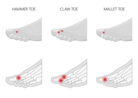 Hammer Toe Causes, Symptoms, and Treatment | BioSkin Bracing