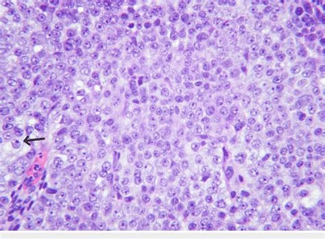 The epithelioid cells display prominent nucleoli and nuclear atypia (40x). | Download Scientific ...