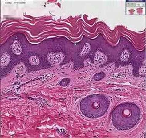 Histopathology Skin - Lamellar Ichthyosis • Video • MEDtube.net