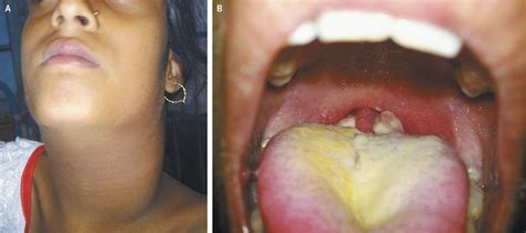 Respiratory Diphtheria - MEDizzy