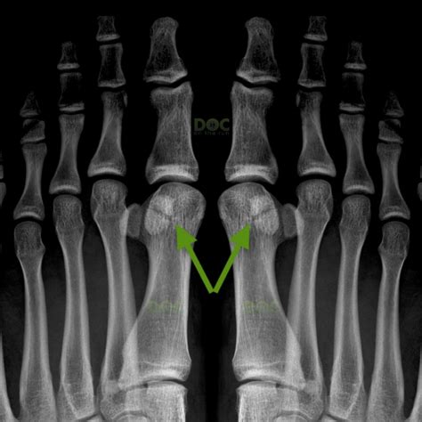 bipartite sesamoid Archives - DOC