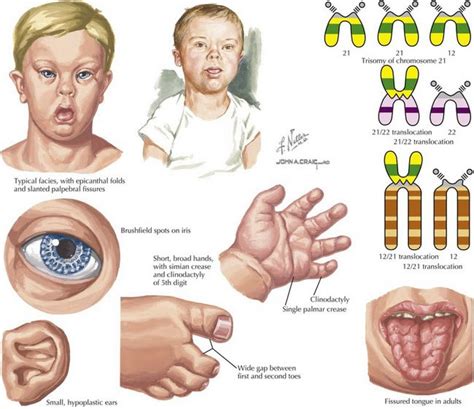 What Exactly is Down Syndrome?