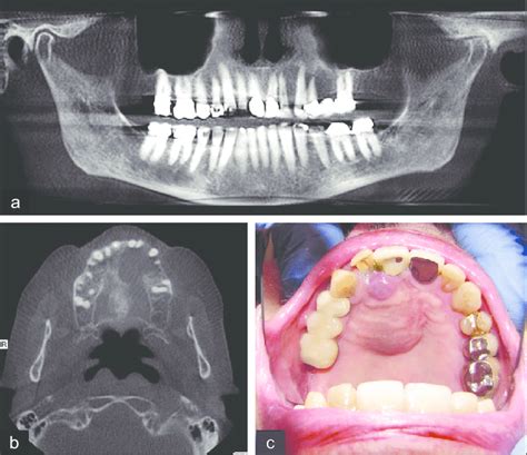 Maxillary Giant Cell Granuloma