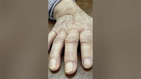 An elderly patient with loss of skin turgor due to dehydration - YouTube