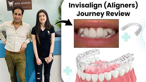 Invisalign (Aligners) Journey Before and After Review | Invisible ...