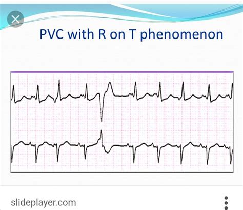 R on T PVC- PVC at the peak of the T wave. Can proceed VFib. | Map ...