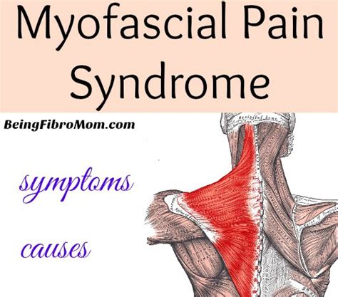 Myofascial Pain Syndrome