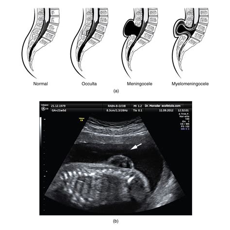 How Might Spina Bifida Be Treated? - StoryMD