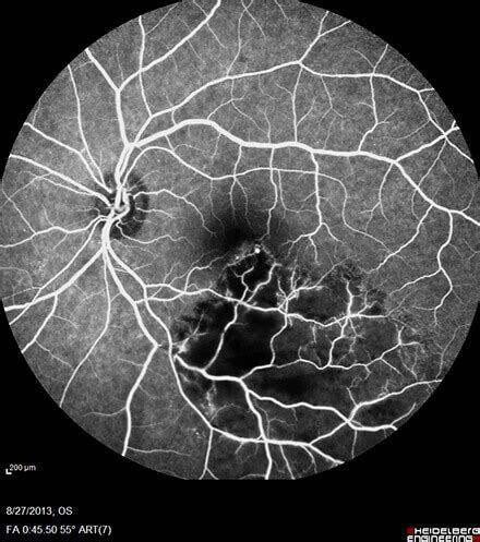 Branch Retinal Vein Occlusion Orlando | Central Florida Retina