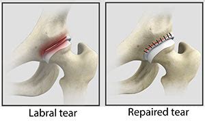 Hip Labral Tear Saginaw, MI | Hip Arthroscopy Midland, Bay City, MI