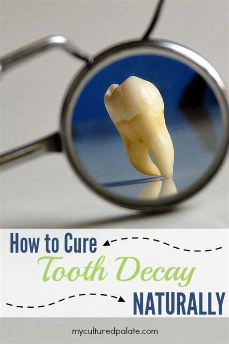 Cure Tooth Decay Naturally