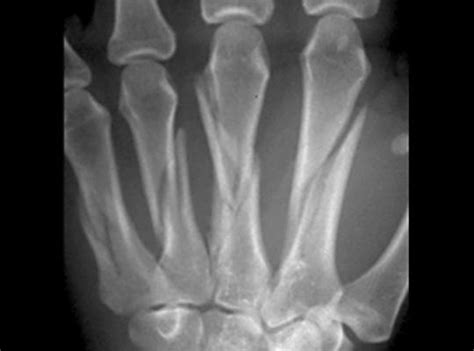 Metacarpal Fractures - Hand - Orthobullets