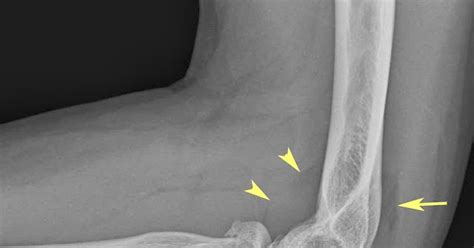 Intra Articular Fracture - Fracture Treatment