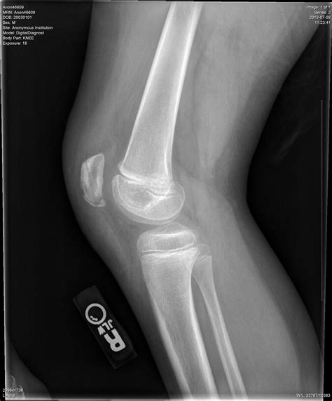 Patellar Sleeve Fracture - The Western Journal of Emergency Medicine