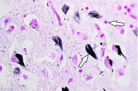 Amyloid plaques (pink) and neurofibrillary tangles (black) in ...