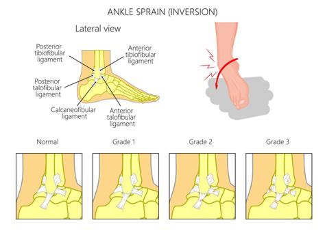 Ankle Sprain Patient Info