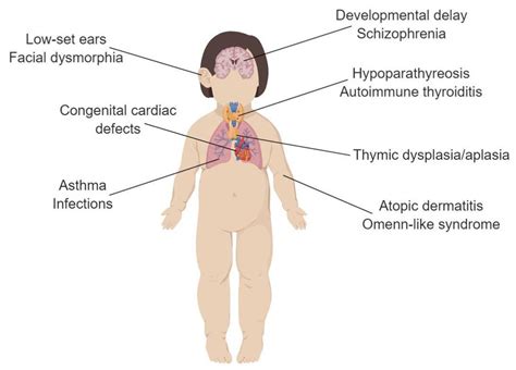 Clinical phenotype of patients with DiGeorge syndrome. Patients are ...