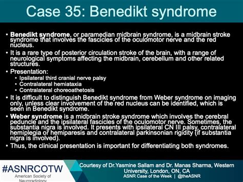 Paramedian Midbrain Syndrome