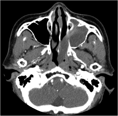 Antrochoanal Polyp and Migrated Dental Implant in the Ipsilateral ...