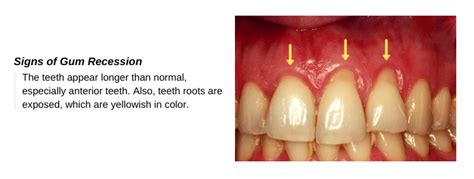 Gum Recession: Can Gums Grow Back? - Share Dental Care