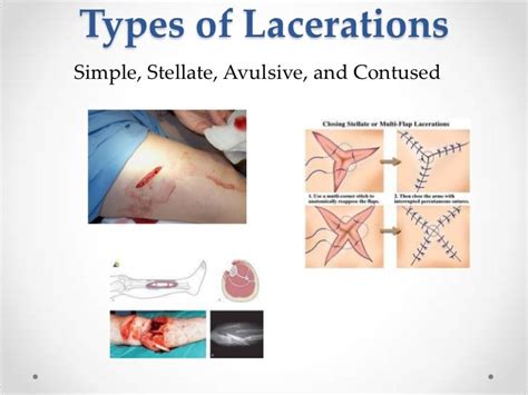 Types Of Wounds Laceration