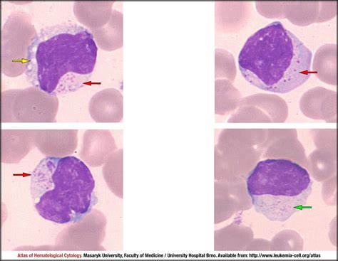 T-cell large granular lymphocytic leukaemia - CELL - Atlas of Haematological Cytology