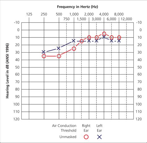 Audiometry Screening and Interpretation | AAFP