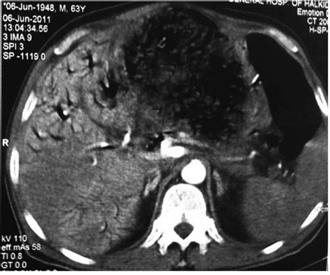 Axial computed tomography contrast ehnanced. | Download Scientific Diagram