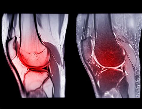 All About ACL Ruptures — Suzie Foreman Physiotherapy