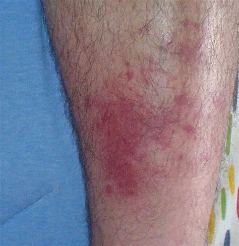 Cellulitis from bug bites: Signs, symptoms, and treatment