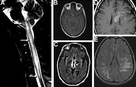 Current concept of neuromyelitis optica (NMO) and NMO spectrum ...