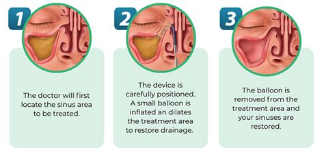 Balloon Sinuplasty l Chronic Sinus Relief l Murfreesboro Sinus