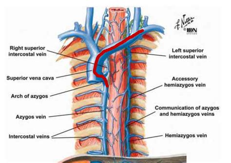 Learning Radiology - Central, Venous, Catheter, Azygos, Vein